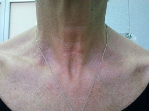 Cicatrice dopo tiroidectomia
